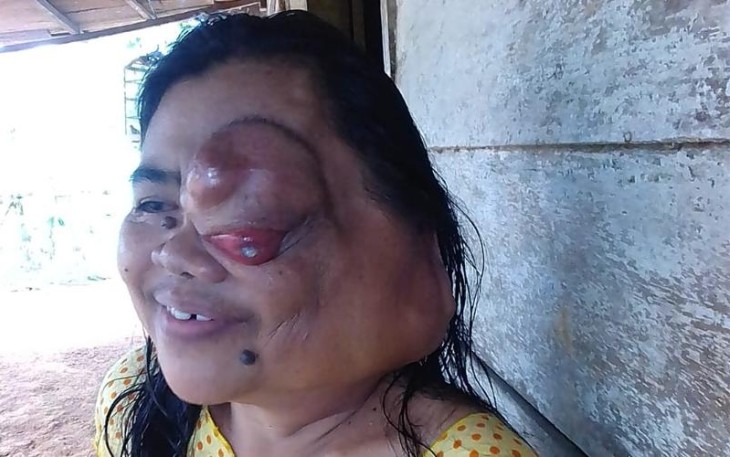 Sunarmi Warga Melati Harjo Butuh Perhatian dan Uluran Tangan Dermawan