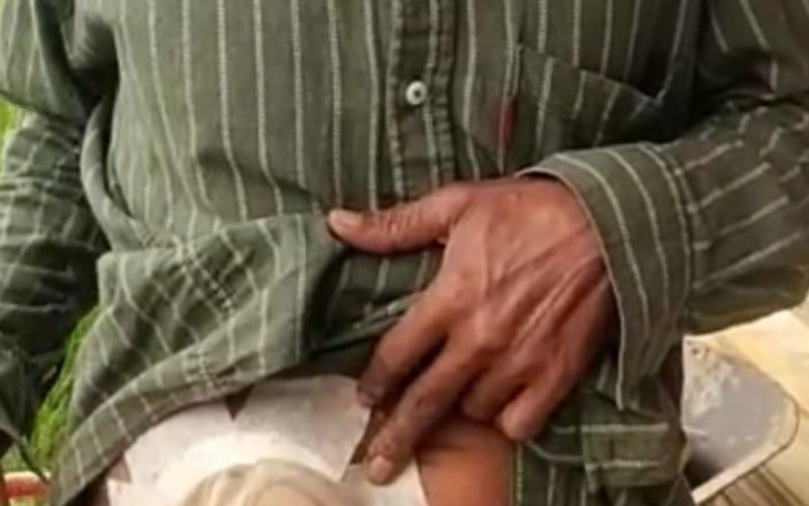 Iwan Janwar (55), terpaksa harus dioperasi perut agar bisa Buang Air Besar (BAB).